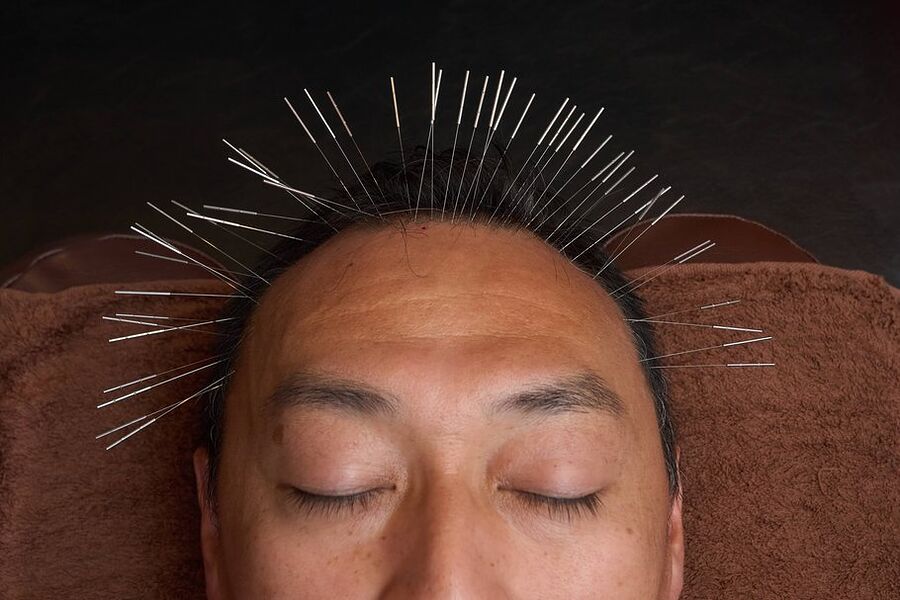 育毛鍼